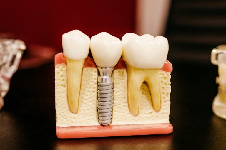 Modell von Zähnen mit einem Implantat in der Mitte und zwei natürlichen Zähnen.