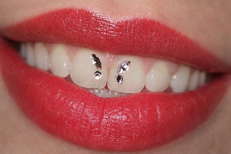 Zwei Zahnmodelle: Ober- und Unterkiefer, farblich unterschiedlich.